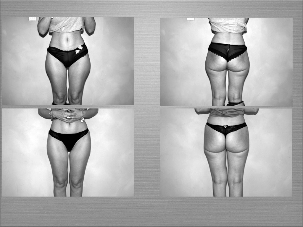 Chirurgie silhouette résultat 3