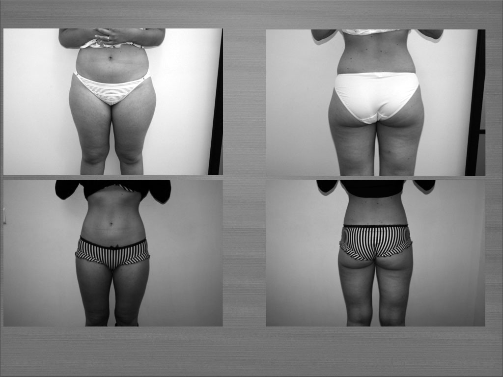 Chirurgie silhouette résultat 4