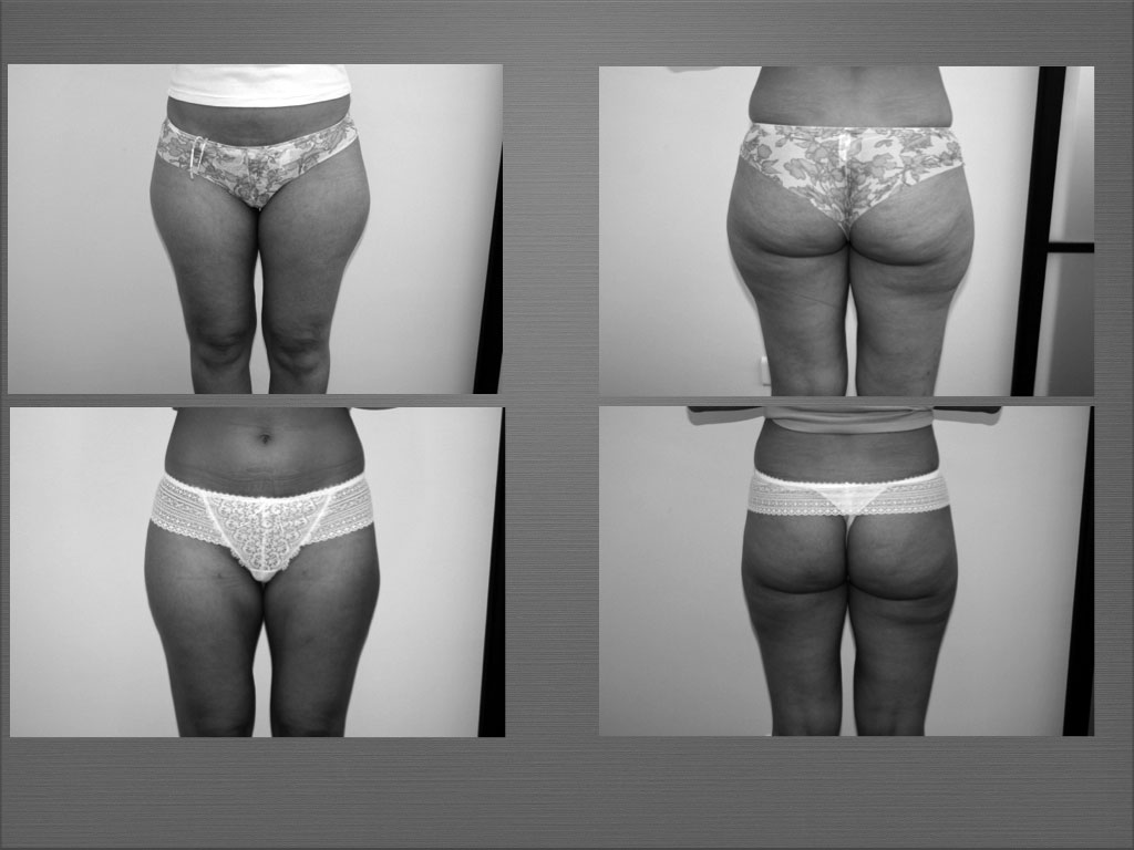 Chirurgie silhouette résultat 5