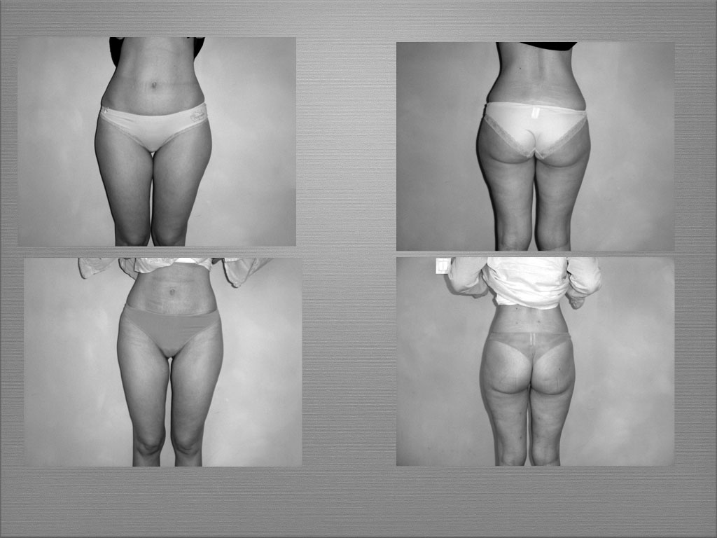 Chirurgie silhouette résultat 6