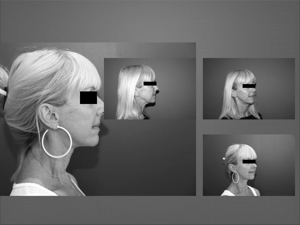 Chirurgie du visage résultat 1