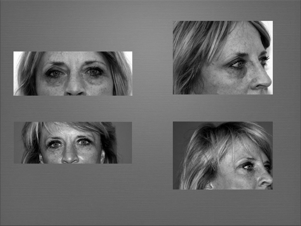 Chirurgie du visage résultat 2