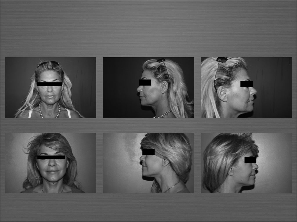 Chirurgie du visage résultat 6